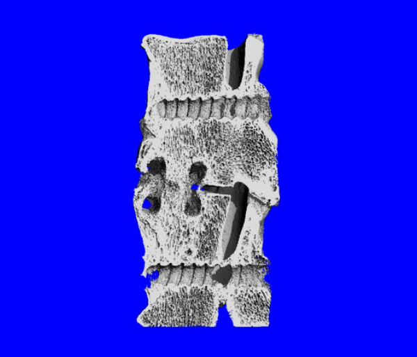 Photo of Spinal fusion on blue background