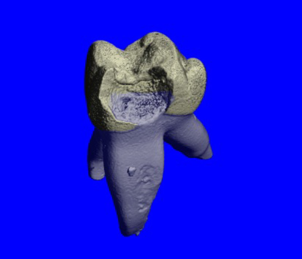 Photo of Tooth decay on blue background