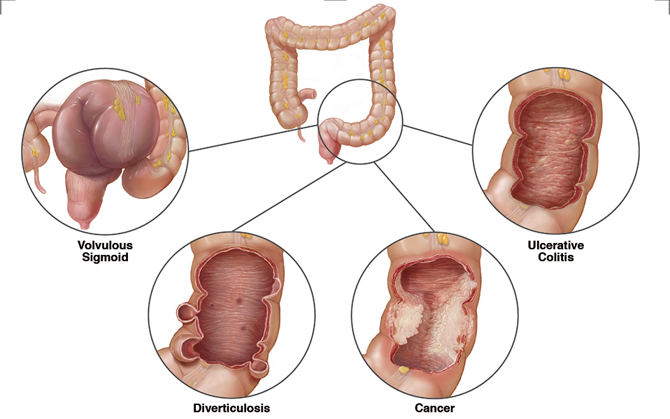 book colon cancer