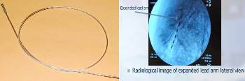 neuromodulation lead