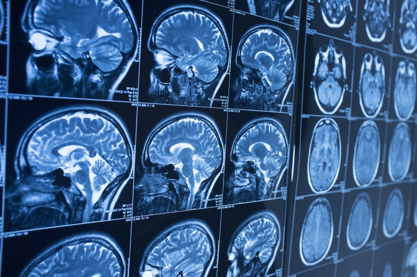 A blue-colored grid of brain scan images.