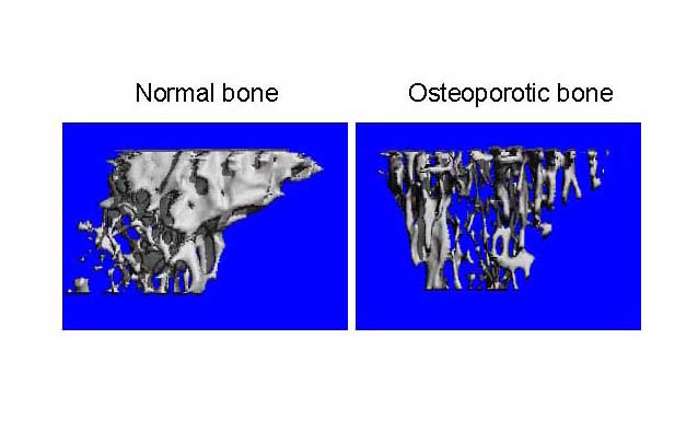 two scans, one of a normal bone and one of an osteoporotic bone