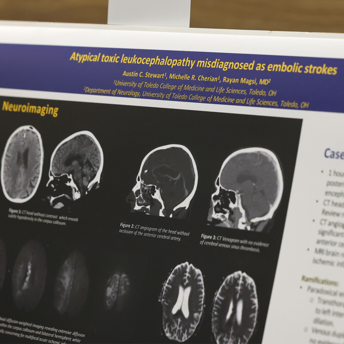 Research poster titled "Atypical toxic leukocephalopathy misdiagnosed as embolic strokes" by researchers, featuring multiple brain CT and MRI neuroimaging scans displayed across the poster.