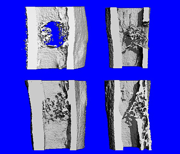 Photo of Bone injury healing on blue background