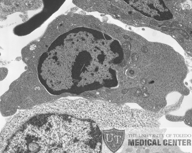 congenital dyserythropoietic anemia