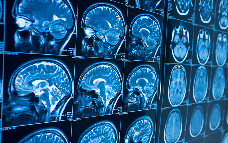 screen depicting mulitple x rays of a brain scan 
